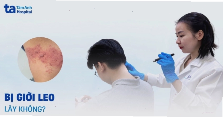 Khả năng lây lan của bệnh giời leo