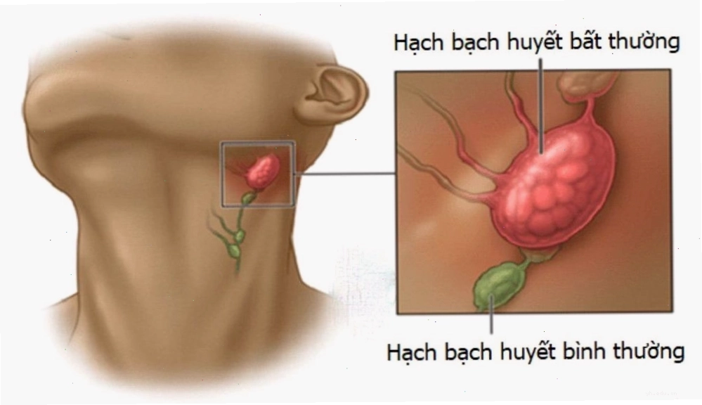 Khám phá vị trí nổi hạch trên cơ thể