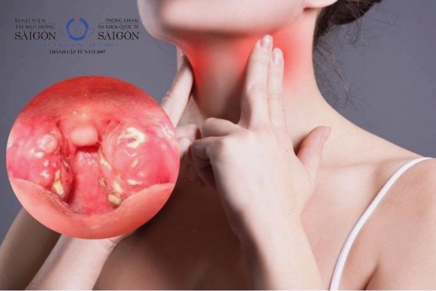 Khô cổ họng do viêm amidan