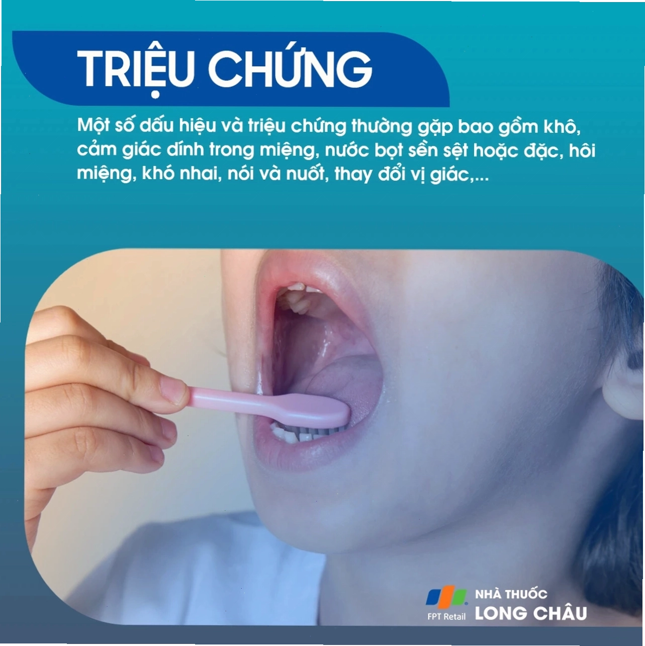 Khô miệng giai đoạn tiến triển