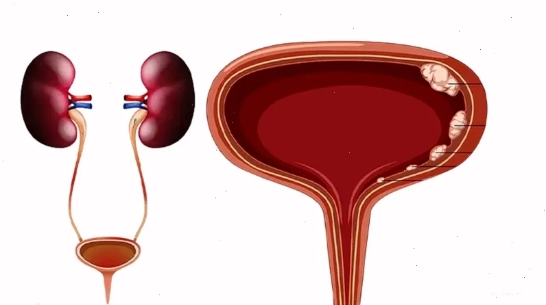 Khối u bàng quang có thể gây ra hiện tượng tiểu ra máu