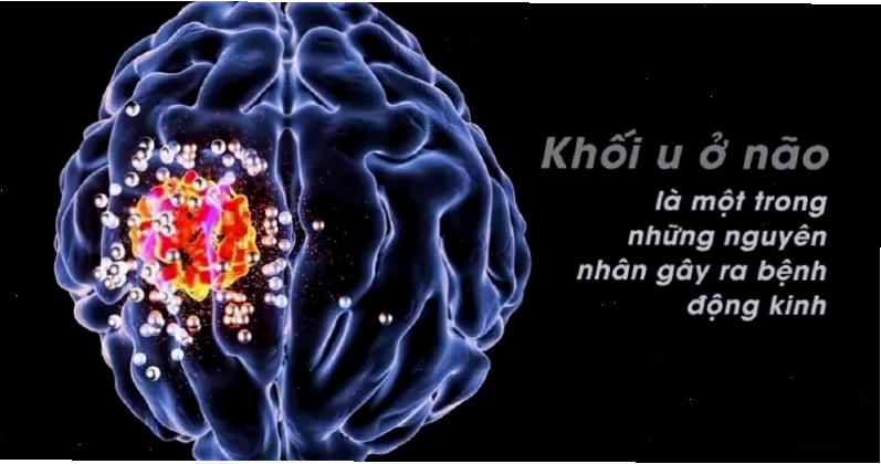 Khối u não có thể là nguyên nhân gây co giật