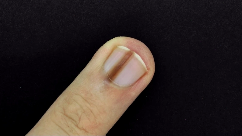 Không phải mọi trường hợp móng tay bị thâm đen đều là bệnh lý nguy hiểm
