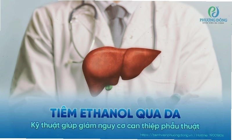 Kỹ thuật tiêm ethanol qua da hỗ trợ điều trị