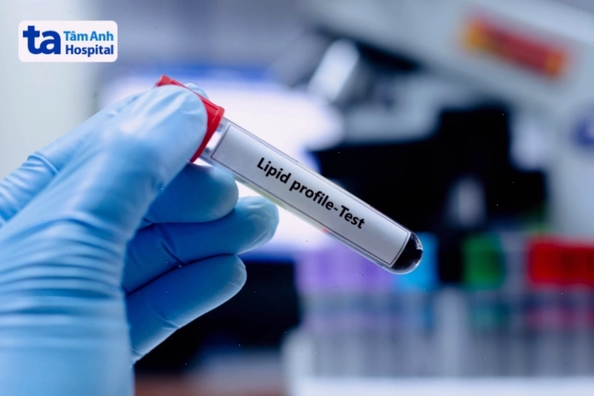 Kỹ thuật xét nghiệm máu để chẩn đoán rối loạn lipid