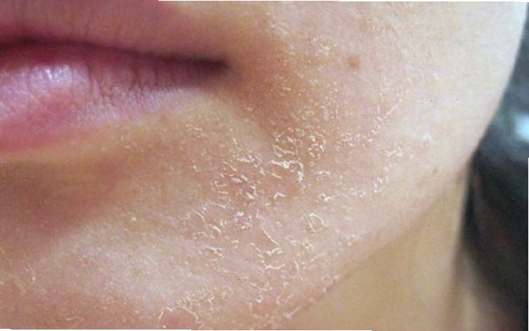 Làn da khô sạm là biểu hiện rõ nét của tình trạng cơ thể đang bị thiếu nước