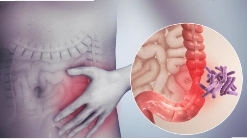 Lao ruột là tình trạng vi khuẩn lao tấn công vào niêm mạc đường ruột gây bệnh