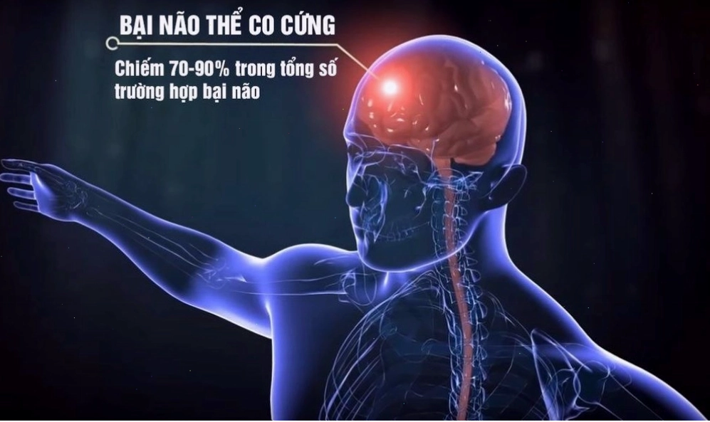 Liệu pháp vật lý trị liệu cho trẻ bại não