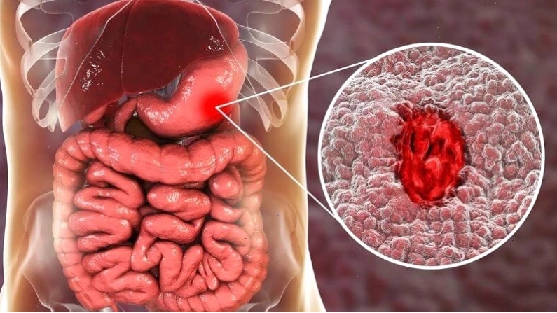 Loét dạ dày là một trong những nguyên nhân đi cầu ra máu