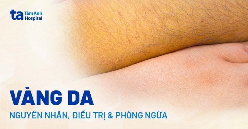 Lòng bàn tay màu vàng là bệnh gì và những điều bạn cần đặc biệt lưu tâm