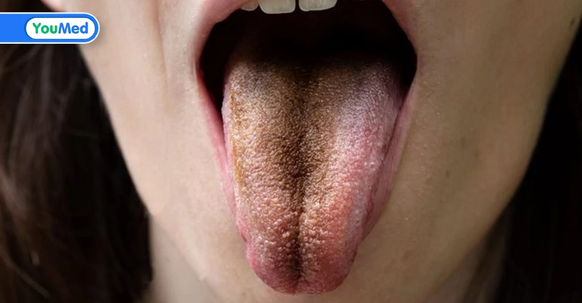 Lưỡi chuyển màu đen là bệnh gì và những điều bạn cần đặc biệt lưu ý