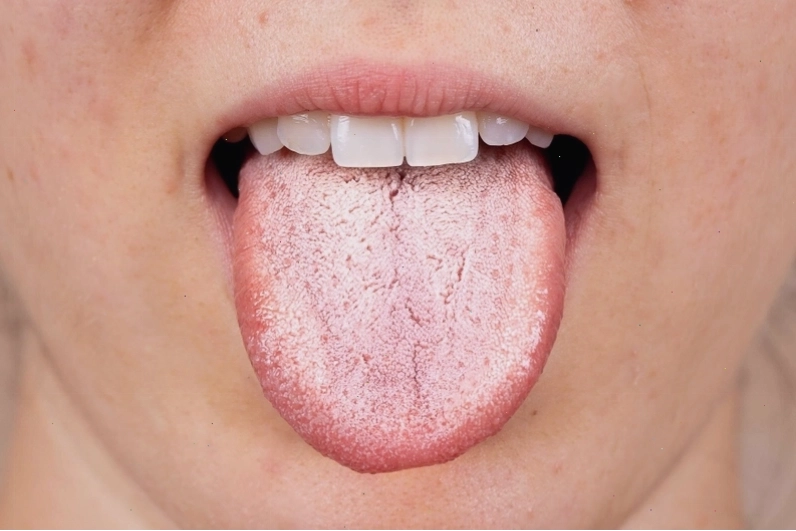 Lưỡi có mảng trắng dày gây khó chịu