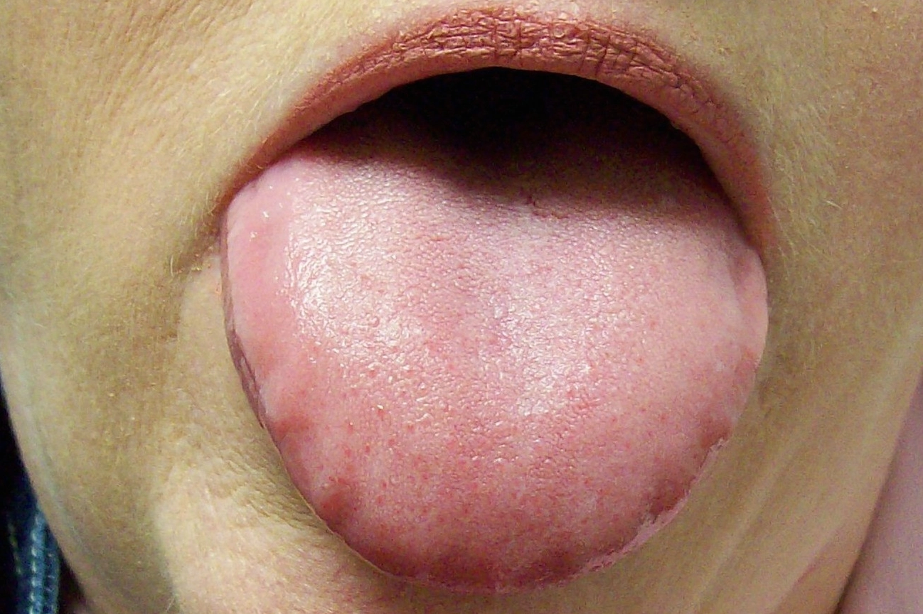 Lưỡi đen mắc bệnh gì và dấu hiệu cảnh báo sức khỏe cần lưu ý
