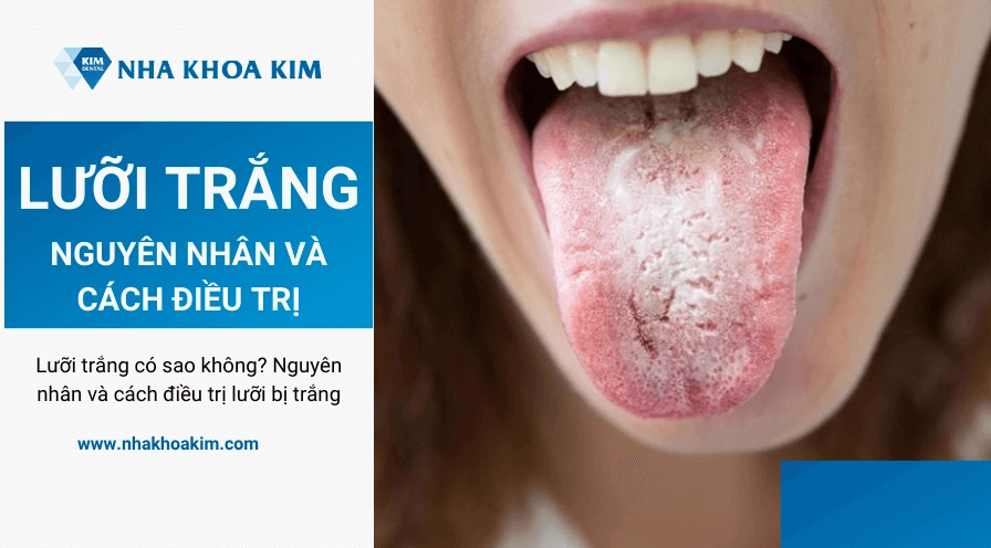 Lưỡi dơ là bệnh gì và những dấu hiệu cảnh báo sức khỏe quan trọng