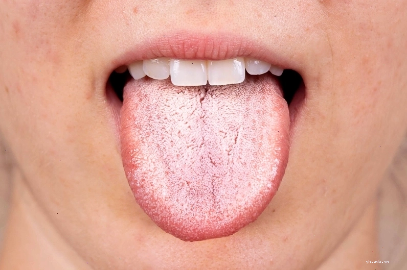 Lưỡi trắng có nguy hiểm không 1