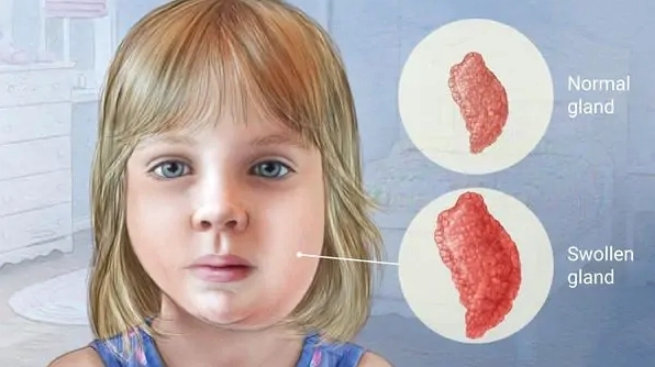 Má chàm bàm là bệnh gì và những kiến thức y khoa quan trọng cần biết