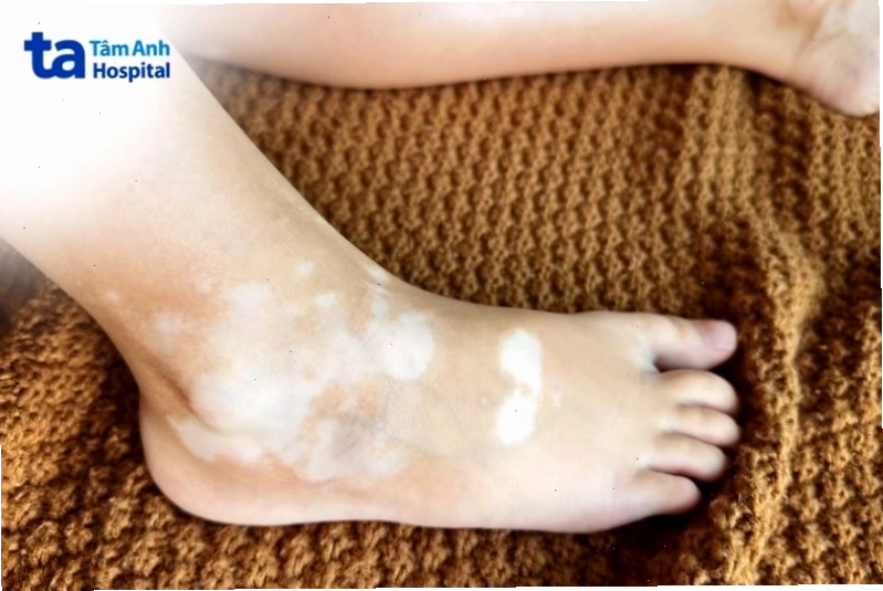 Mảng bạch biến xuất hiện ở vùng chân