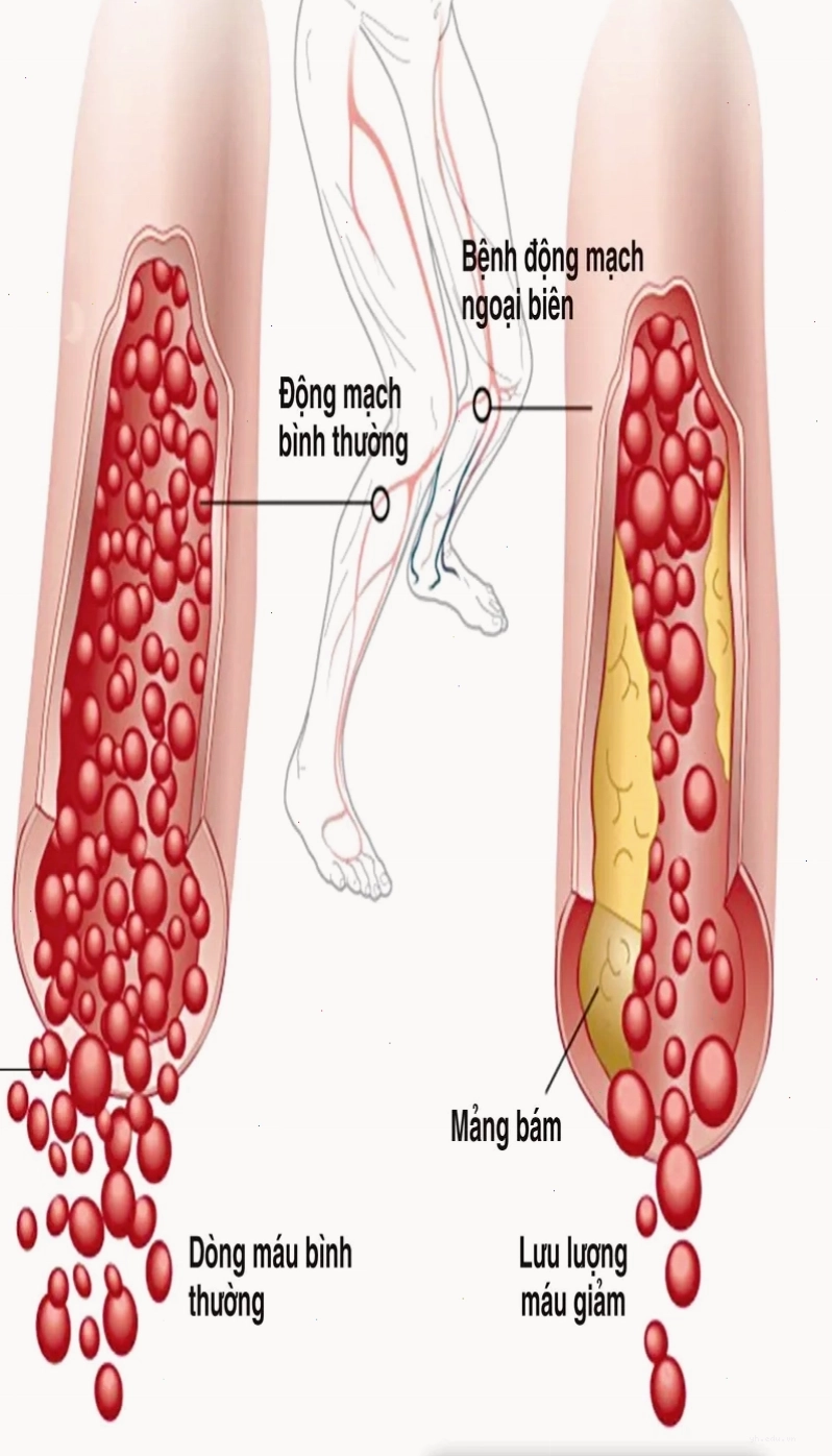 Mảng xơ vữa làm hẹp động mạch chi