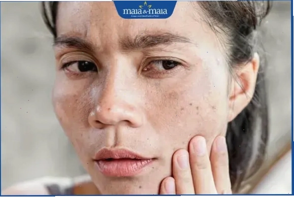 mặt nổi đốm đen