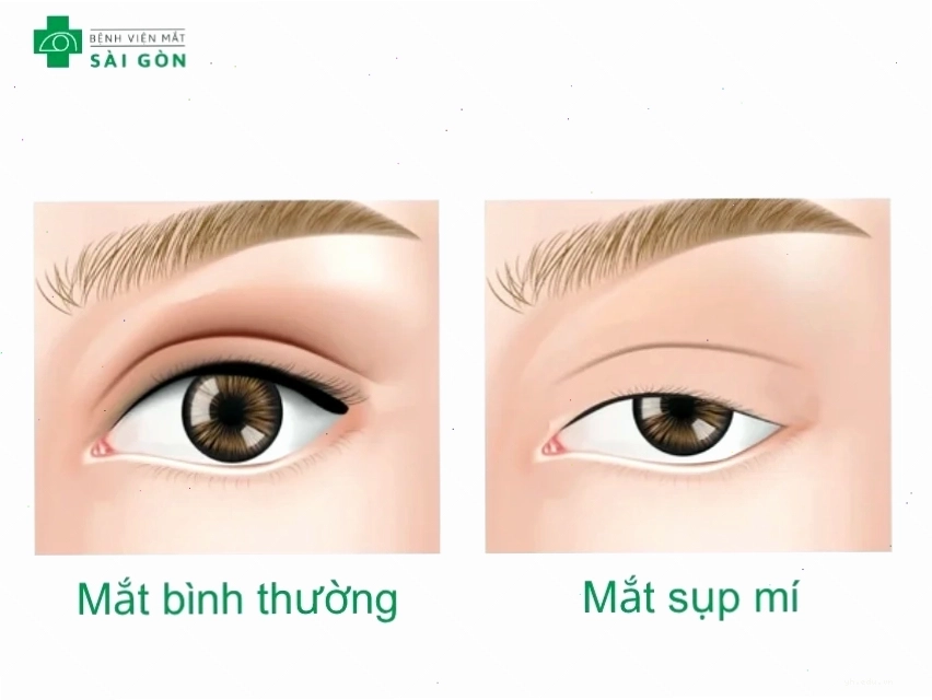 Mi trên mắt có vị trí thấp hơn bình thường khi nhìn thẳng