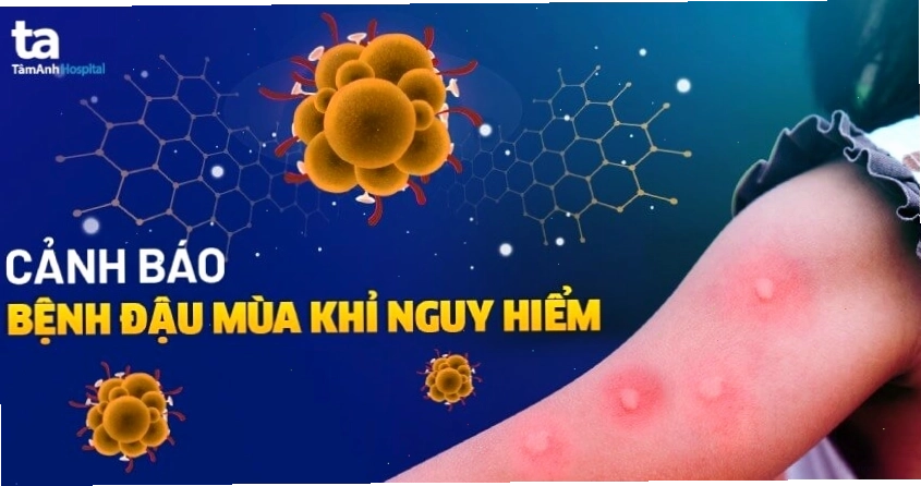 Minh họa bệnh đậu mùa khỉ là gì