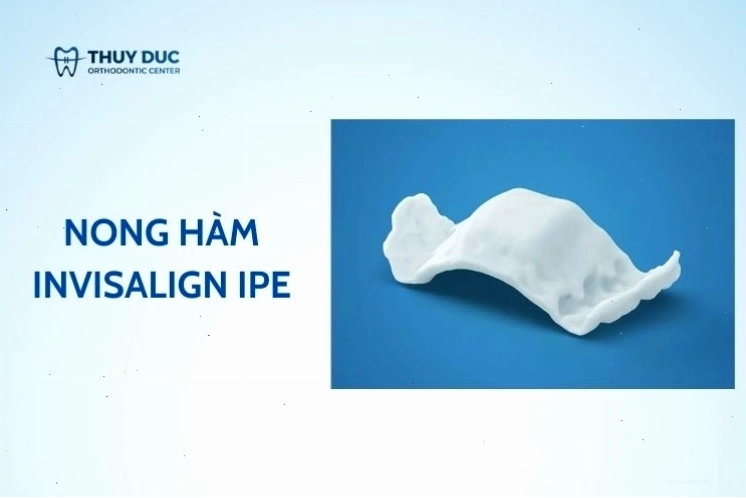 Minh họa các giải pháp chỉnh nha giúp khoang miệng sạch sẽ hơn