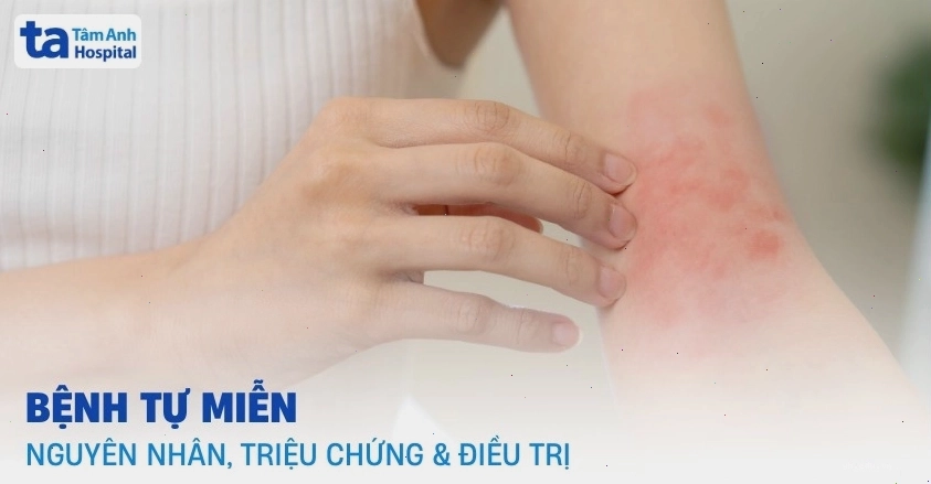 Minh họa cơ chế hoạt động của bệnh tự miễn trong cơ thể