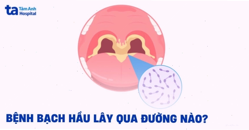 Minh họa cơ chế lây lan bệnh bạch hầu qua đường hô hấp