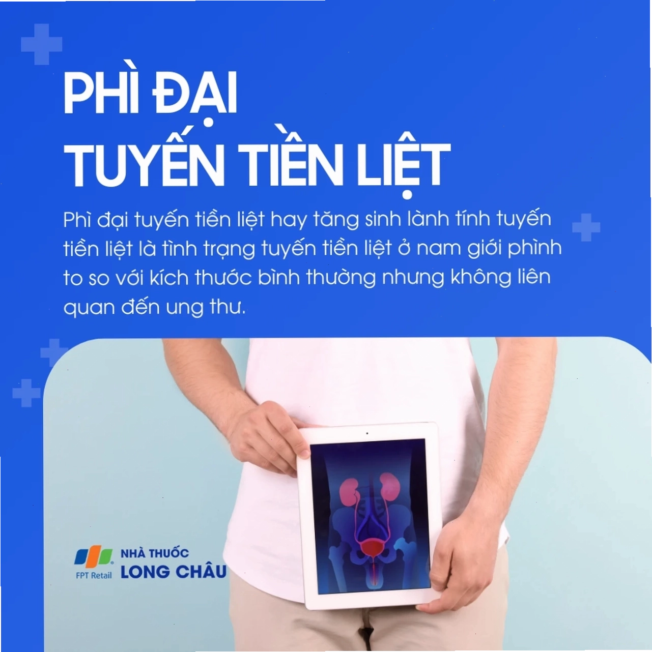 Minh họa giải phẫu tuyến tiền liệt bị phì đại gây ép vào đường niệu đạo