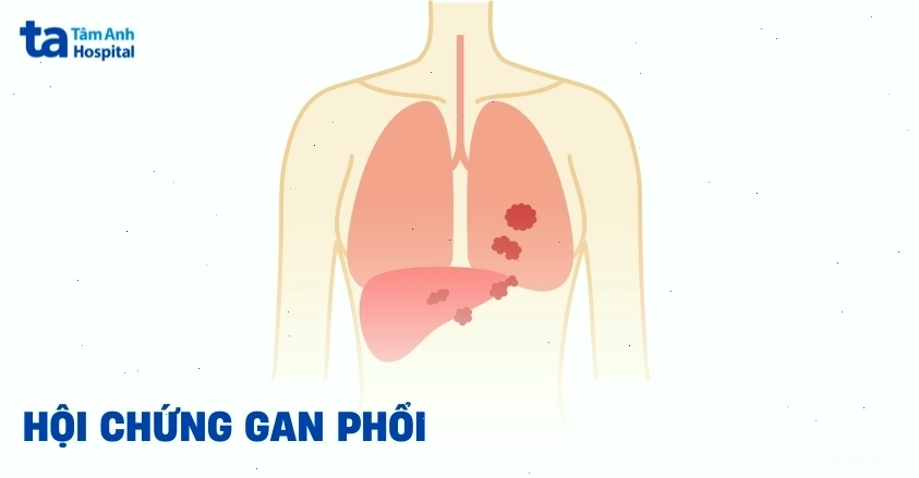 Minh họa hội chứng gan phổi có liên quan đến các biến chứng y khoa