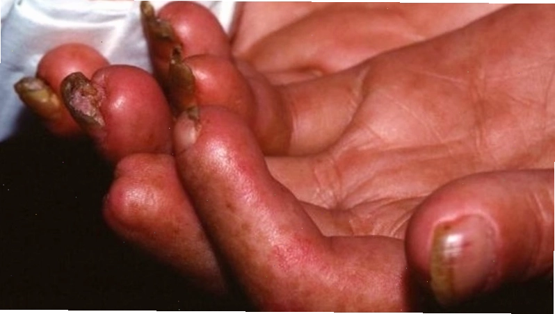 Minh họa khái niệm tổng quan về bệnh xơ cứng