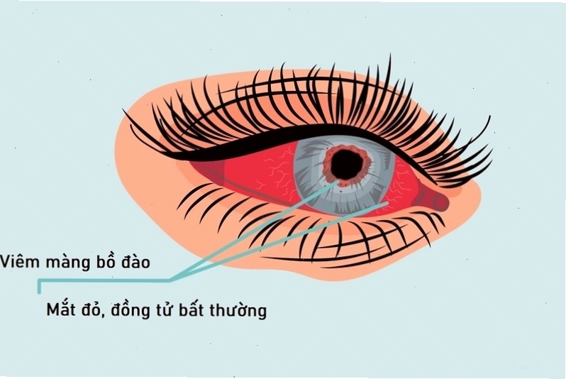 Minh họa quá trình theo dõi điều trị viêm màng bồ đào