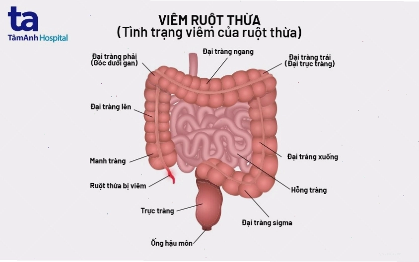 Minh họa quá trình ủ bệnh viêm ruột thừa