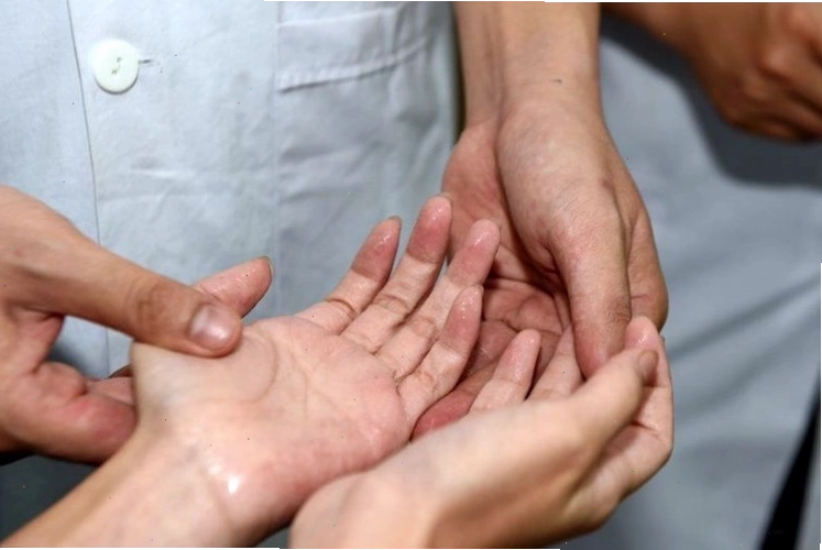 Minh họa tình trạng rối loạn thần kinh thực vật gây đổ mồ hôi tay chân liên tục