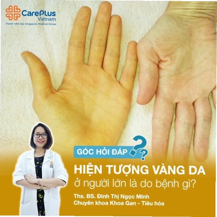 Minh họa tình trạng vàng da vàng mắt ở người trưởng thành