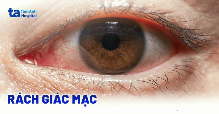 Minh họa tổn thương giác mạc