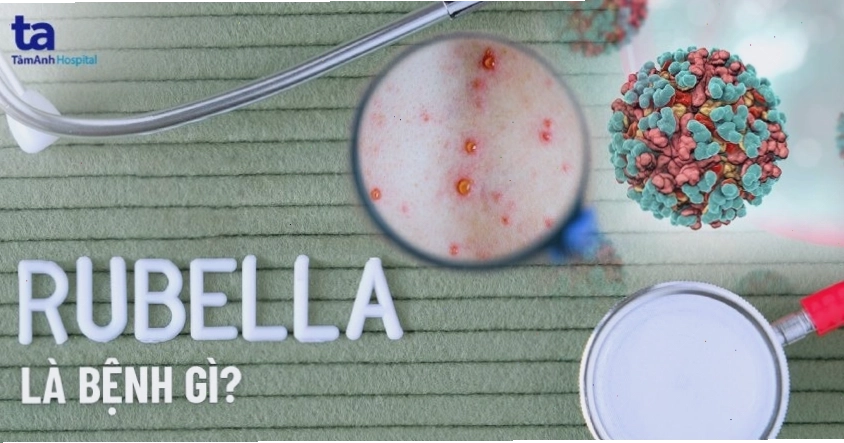 Minh họa tổng quan về bệnh Rubella