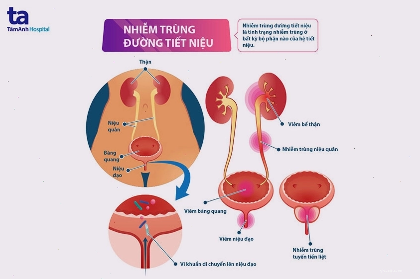 Minh họa vi khuẩn xâm nhập đường tiết niệu