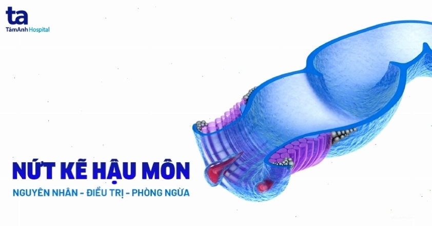 Mô phỏng giải phẫu học vùng niêm mạc hậu môn bị tổn thương
