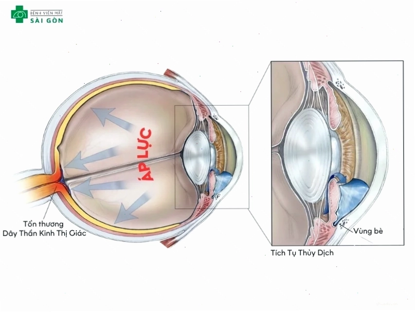 Mô phỏng sự tích tụ thủy dịch trong nhãn cầu