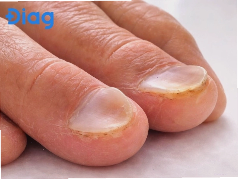 Mô tả cấu trúc móng tay bị lõm ở giữa và cong ngược lên ở rìa