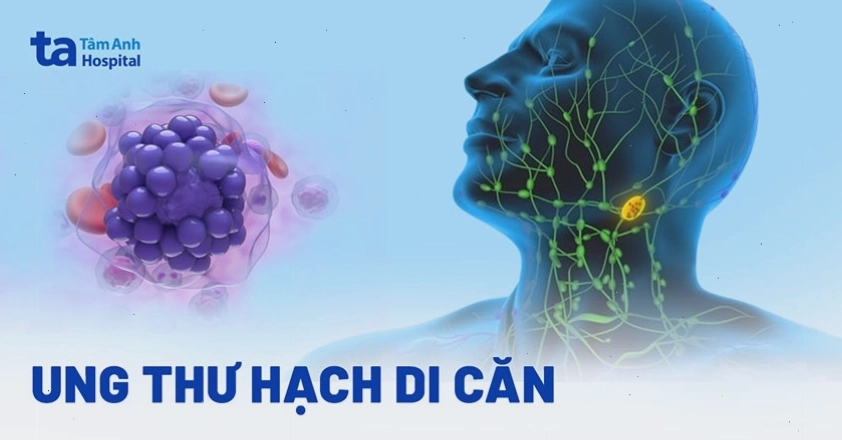Mô tả tình trạng ung thư hạch di căn ảnh hưởng đến các cơ quan lân cận