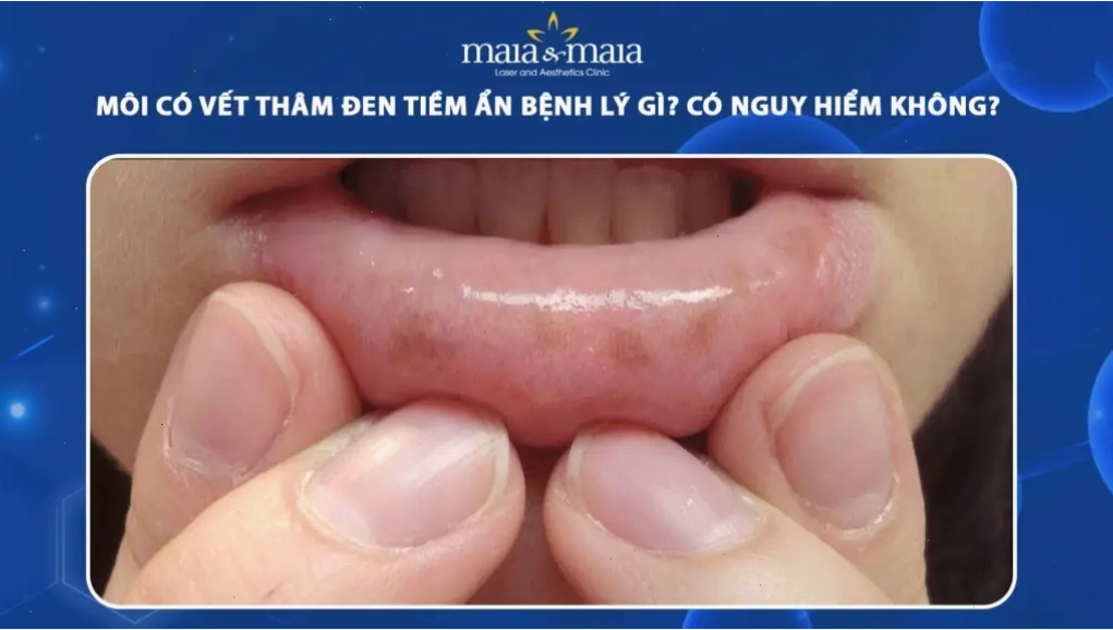 Môi có vết thâm đen