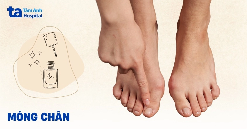 Móng chân màu tím là bệnh gì và những dấu hiệu sức khỏe cần chú ý