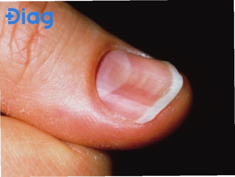 Móng tay bị lõm hình thìa có thể do nhiều nguyên nhân bệnh lý và dinh dưỡng khác nhau