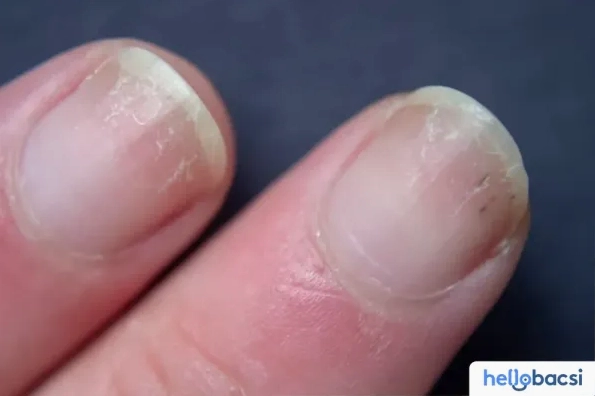 Móng tay bị sần sùi là bệnh gì và cách nhận diện nguy cơ sức khỏe