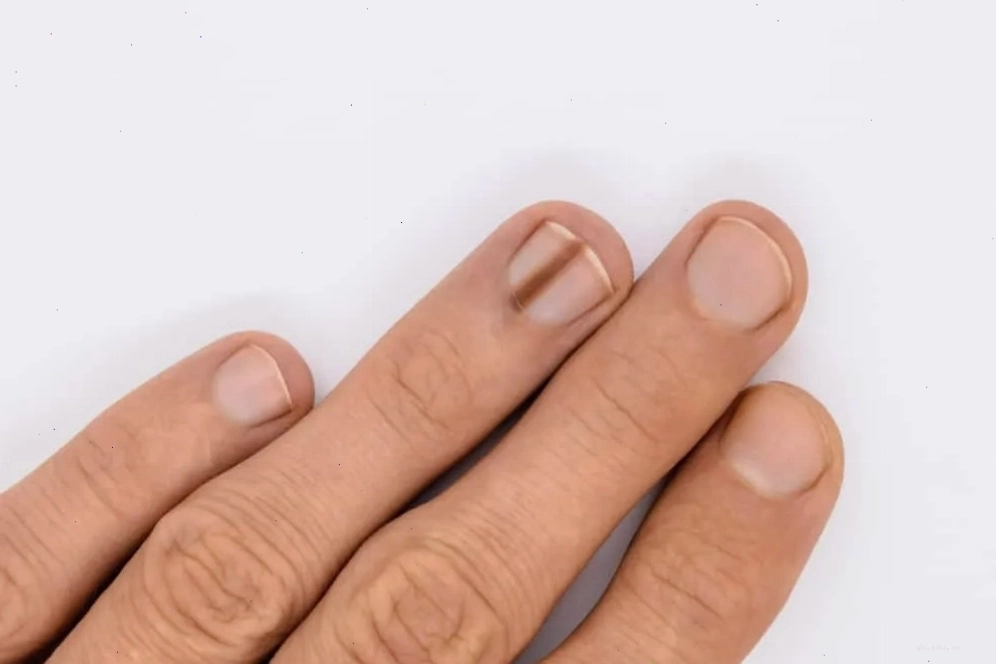 Móng tay bị sọc dọc đen có thể liên quan đến thiếu chất