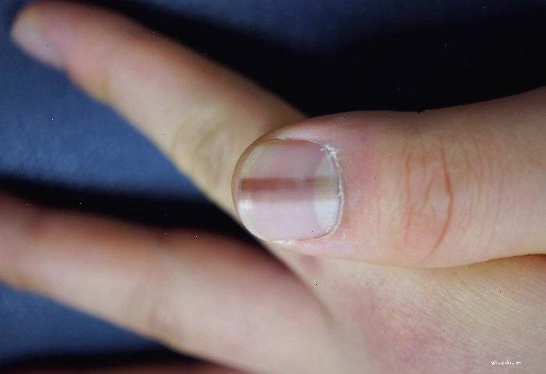Móng tay có sọc nâu đen là dấu hiệu cảnh báo bệnh tật