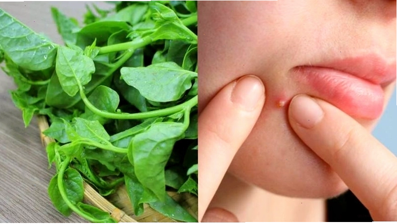 Mồng tơi trị mụn trứng cá và rôm sảy