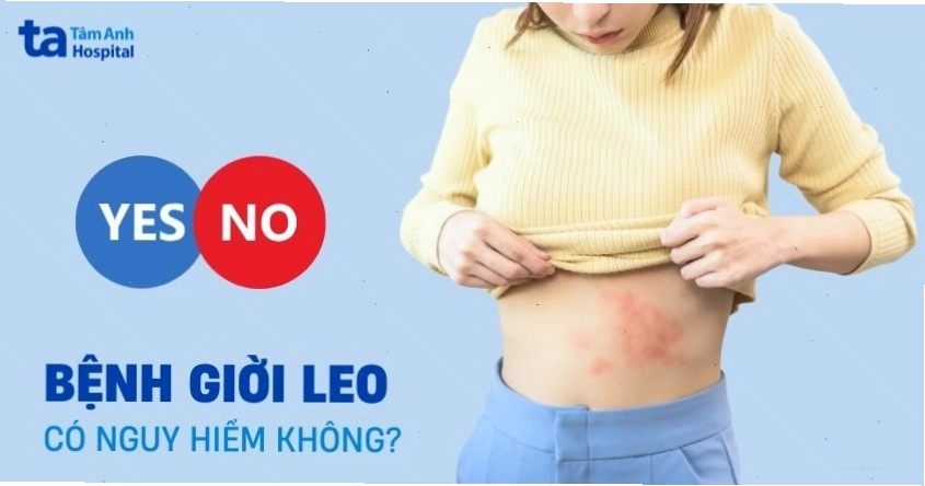 Mức độ nguy hiểm của biến chứng giời leo